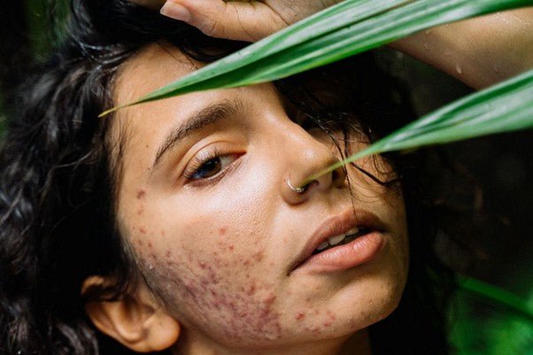 Silk Pillowcases for Acne-Prone Skin - Lunalux